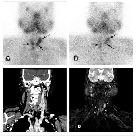 Technetium M Sestamibi A B D Ct C And D Mri D Scans Of The