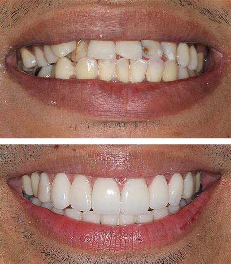 Dental Veneers Types Uses And Process Safar Medical