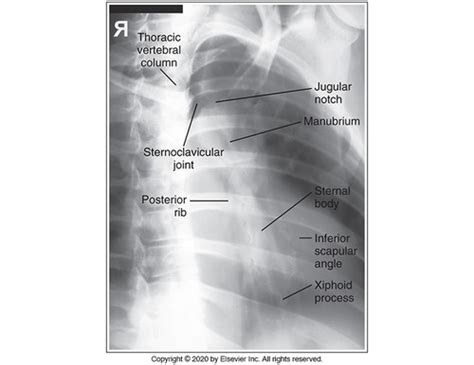 Chapter Ribs And Sternum Flashcards Quizlet