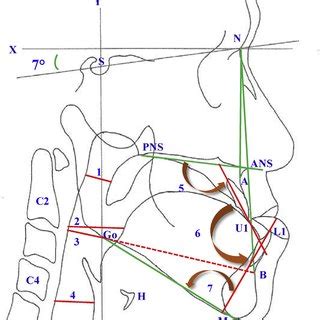 Cephalometric Landmarks And Linear Measurements Landmarks Nasion N