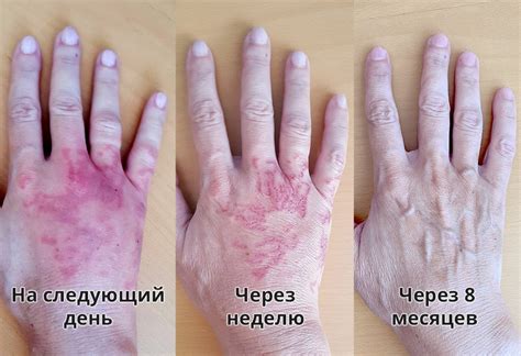 Опасные медузы в Израиле