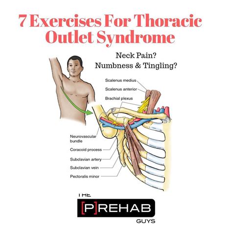 Exercises For Thoracic Outlet Syndrome Neck Arm - Exercise Poster