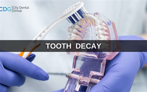 How To Prevent Tooth Decay | Tooth Decay Treatment At Home