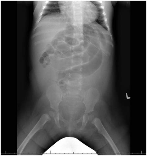 Double Ileoileal Intussusception Following Surgical Reduction Of