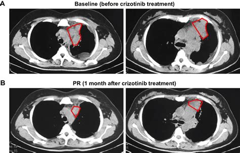 Responses Of A CD74 ROS1 Fusion Patient With Pulmonary Blastoma To