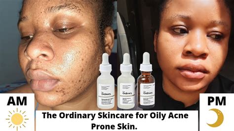 How To Use The Ordinary Skincare Products For Oily Acne Prone Skin