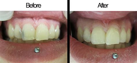 How Long Do Front Teeth Fillings Last Teethwalls