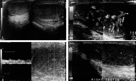 Longitudinal Sonograms Show Testicular Enlargement And In Download