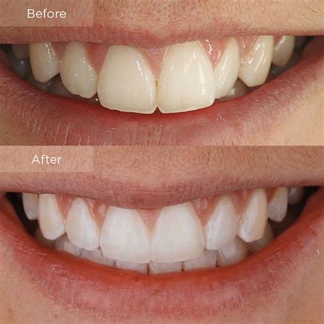 Invisalign Braces Before And After Gaps