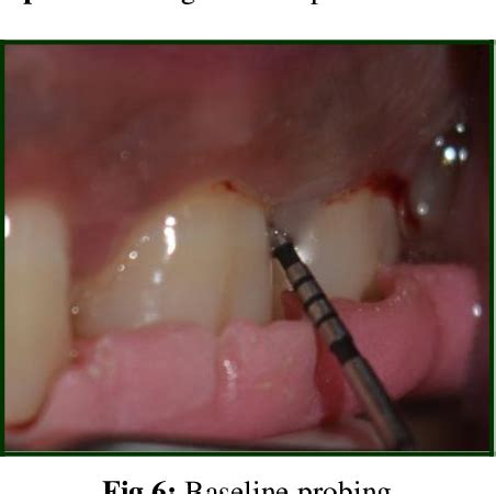 Figure 6 From Open Flap Debridement Using Microsurgical Loupes And