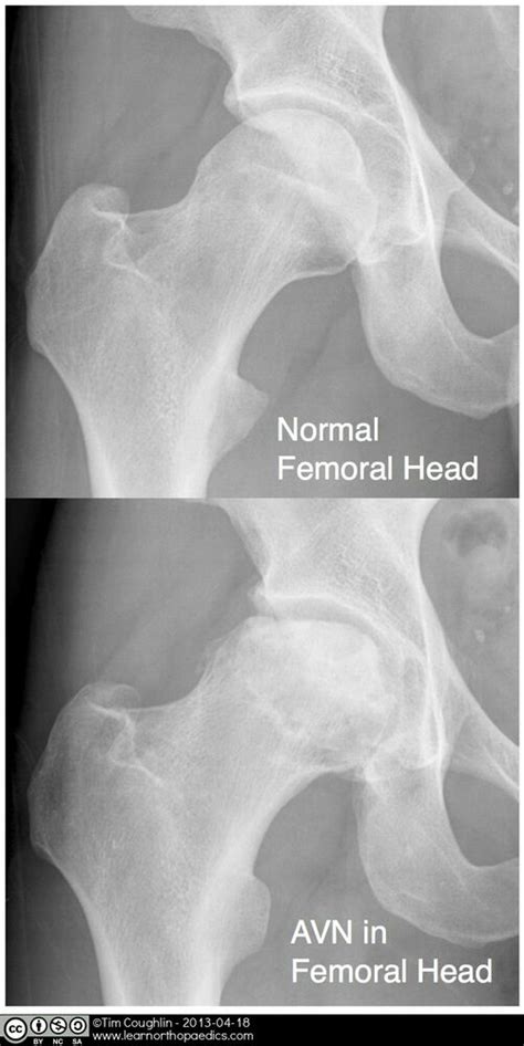 Avascular Necrosis Femoral Head Physiopedia