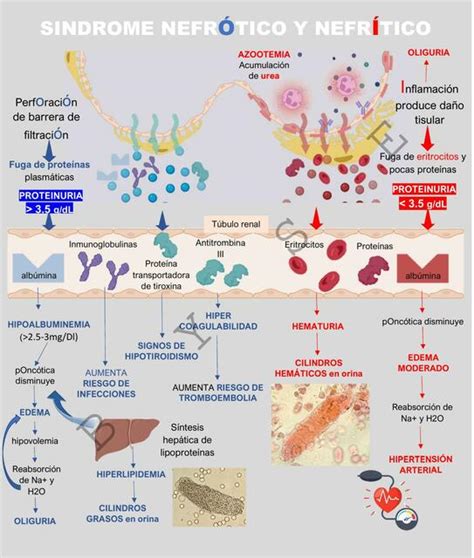 Síndrome Nefrótico y Nefrítico Briggitte Yamilé Suarez Esteban uDocz