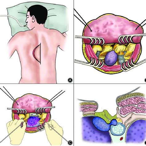 Surgical Diagrams Illustrating The Operation Process A Patients Were