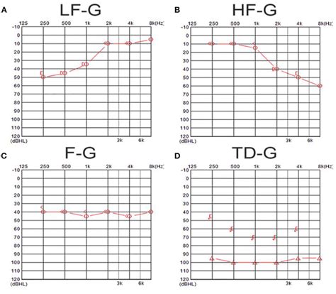 The Examples Of Audiograms In Four Types Of Uissnhl A Shows An