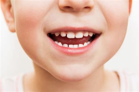 Best Teeth Whitening Solutions For Kids | The Super Dentists