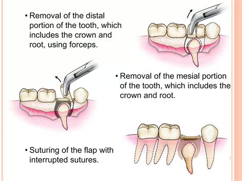 Principles And Steps Of Surgical Tooth Extraction Ppt