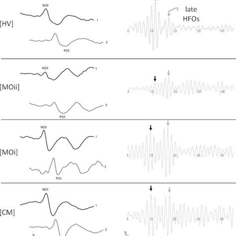 Schematic Representation Of The Changes In Somatosensory Evoked