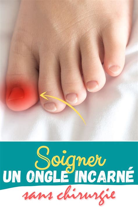 Soigner Un Ongle Incarné Sans Chirurgie Fitbit Flex Fitbit