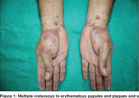 Bullous Lichen Planus Vs Lichen Planus Pemphigoides A Diagnostic