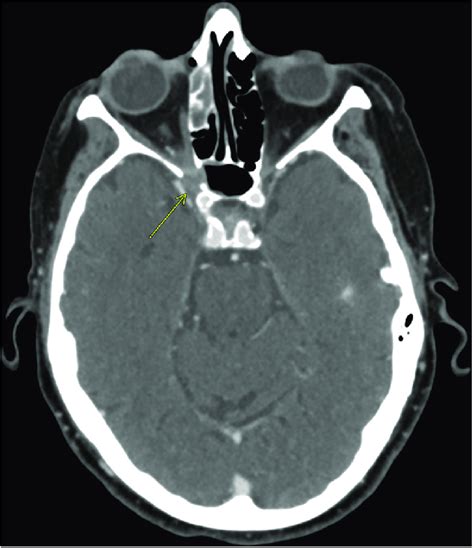 Ct Of The Head And Orbits With Iv Contrast Demonstrating Soft Tissue