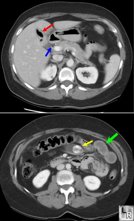 Learning Radiology Gallstone Ileus