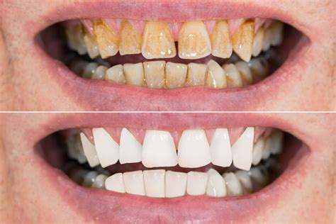 Teeth Discoloration Causes Symptoms Prevention And Cures