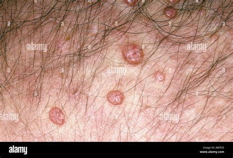 Molluscum Contagiosum Hi Res Stock Photography And Images Alamy