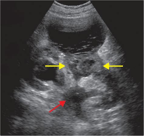 Nephrostomy Tube Ultrasound