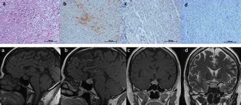 Histopathology Slides And Magnetic Resonance Imaging Of Tumor