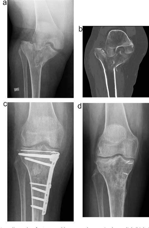 Tibial Plateau Fracture Xray