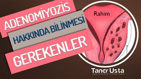 Adenomyozis Nedir Prof Dr Taner Usta Youtube