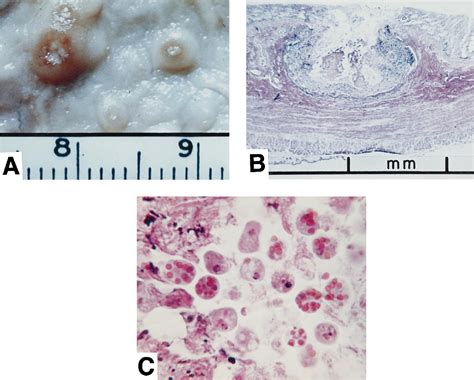 Entamoeba Histolytica Flask Shaped Ulcers