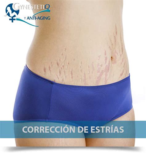 Gynestetiq Tratamiento de estrías