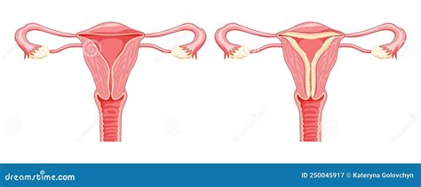 Set Of Endometrial Hyperplasia Female Reproductive System In Normal And Problem Uterus Front