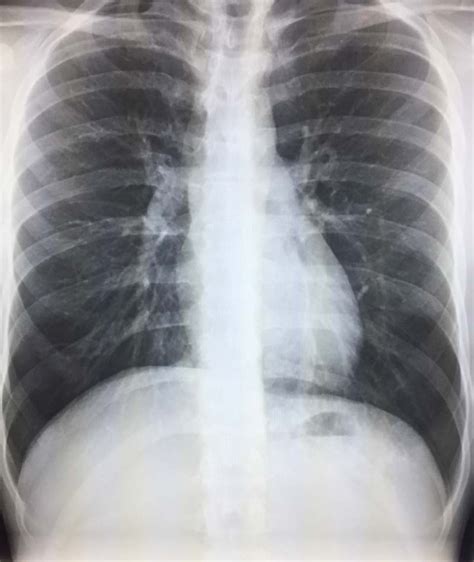 Partially Visualized Lung Nodule on CT – Radiology In Plain English