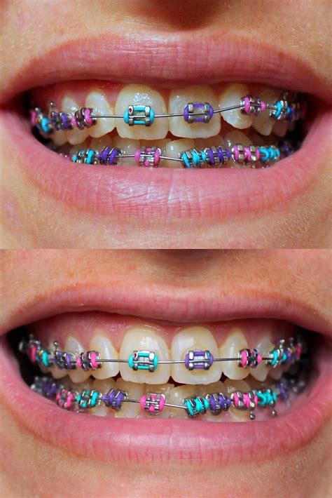 good braces colors for yellow teeth - Crawling With Blogs Photography