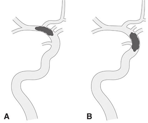 (A) T occlusion (ICA terminus is involved as the occlusion site) and... | Download Scientific ...