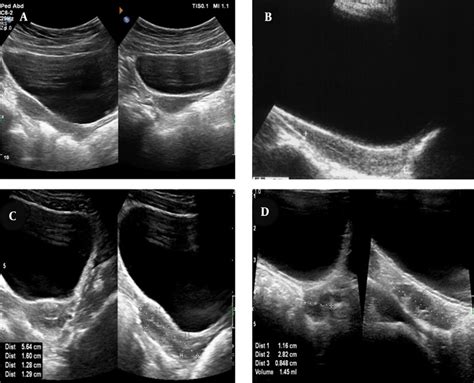 Typical Ultrasonography Us Of The Uterus And Ovaries Of A Cpp Patient