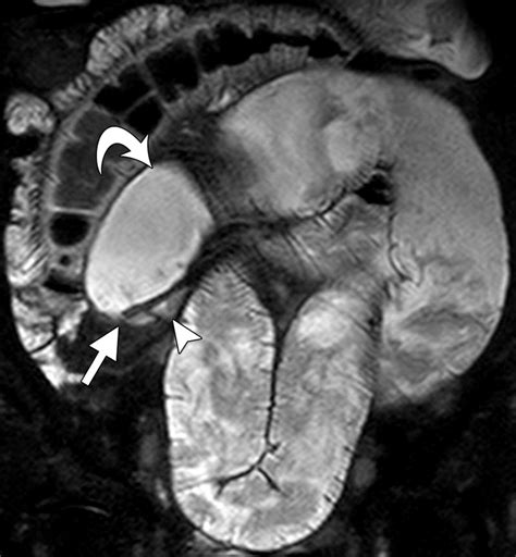 Effectiveness Of Mr Enterography For The Assessment Of Small Bowel