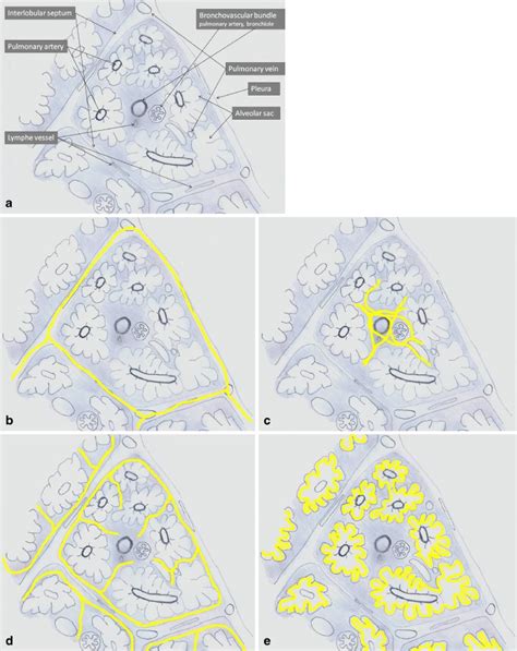 a Anatomy of the secondary pulmonary lobule. b–e The reticular pattern ...