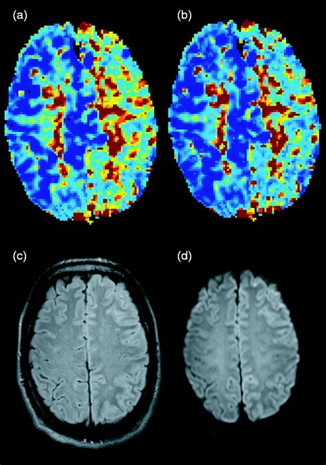 Perfusion And PH MRI In Familial Hemiplegic Migraine With Prolonged