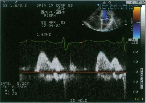 The Pulsed Wave Echo Doppler Signal Measured In The Left Ventricular Download Scientific