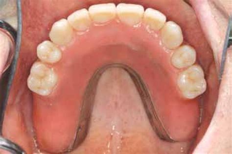 Maxillary Implant Supported Bar Overdenture And Mandibular Implant