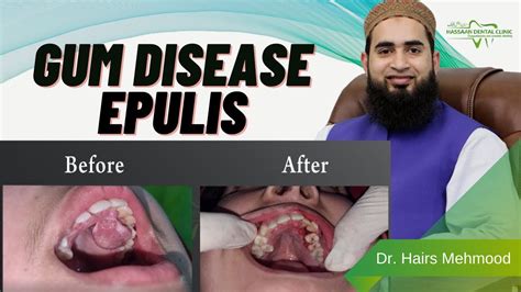 Gum Disease Epulis 2021 Youtube