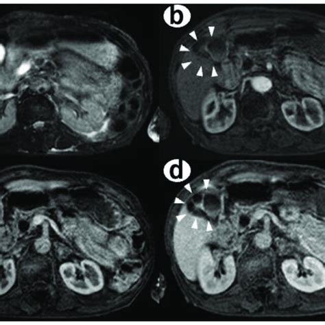 The Axial Images Of Contrast Enhanced Ct Ce Ct Multiple Cystic