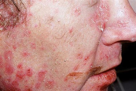 Psoriasis On The Face Symptoms Causes Treatment And 56 OFF