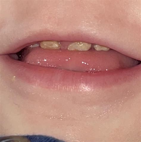 12 Month Olds Teeth Came In Like This What Is Going On And How Did This Happen R Askdentists