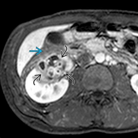 Spermatoceleepididymal Cyst Radiology Key