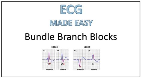 Sinus Rhythm With Right Bundle Branch Block