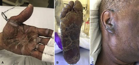 Acrokeratosis Paraneoplastica Bazex Syndrome Associated With